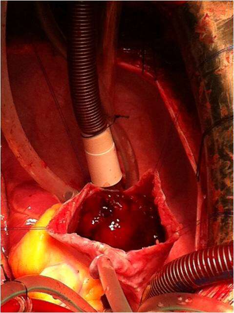 Image 2 Surgical Resection Myxoma